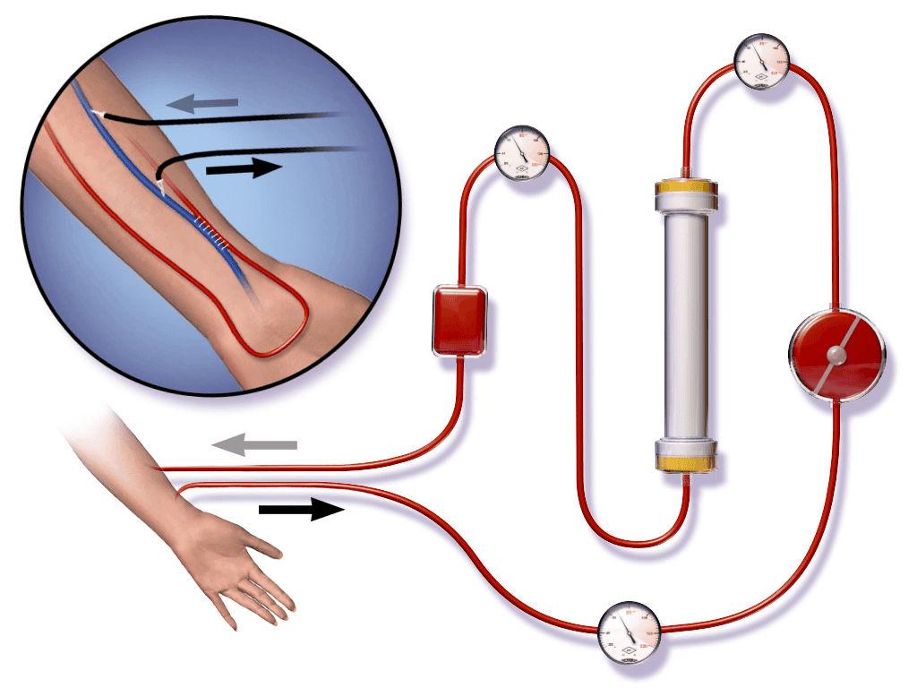 Blausen 0313 Dialysis