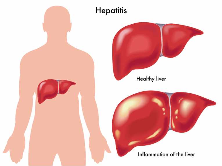 Hepatatitis2